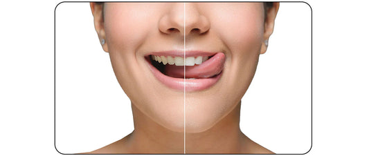 Blog : Jet dentaire pour enlever le tartre - oralirrigator.fr