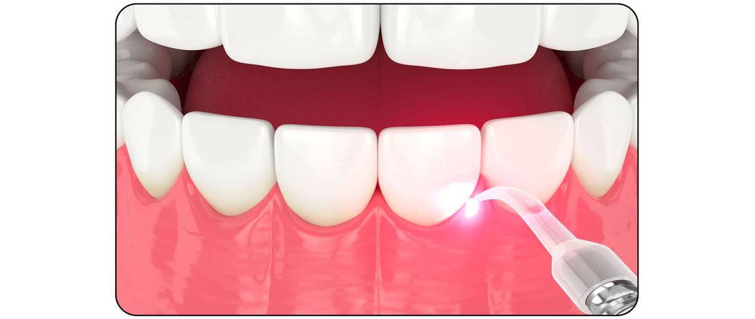 Blog : jet dentaire et parodontite - oralirrigator.fr